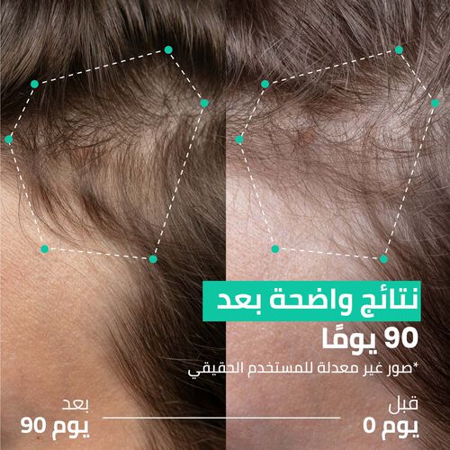 روتين مزدوج الفعالية لتكثيف الشعر - حل لتساقط الشعر في 90 يوم image number null
