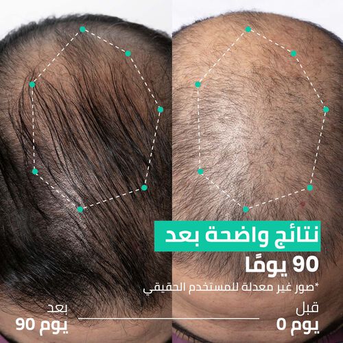 روتين مزدوج الفعالية لتكثيف الشعر - حل لتساقط الشعر في 90 يوم image number null